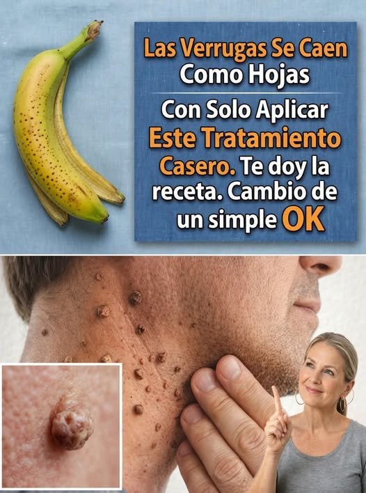 Remedios caseros para verrugas