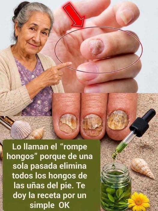 Remedio natural para hongos en uñas