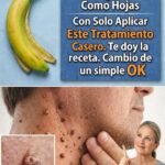 Remedios Naturales para Eliminar Verrugas Fibromas Espinillas y Manchas de la Piel
