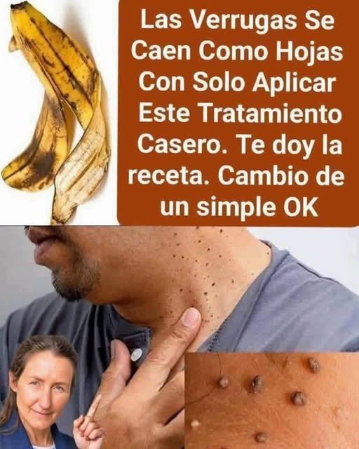 Verrugas en la piel