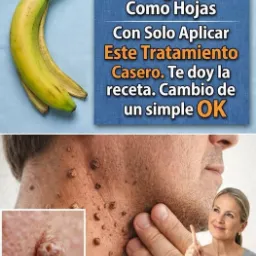 Remedios caseros para verrugas